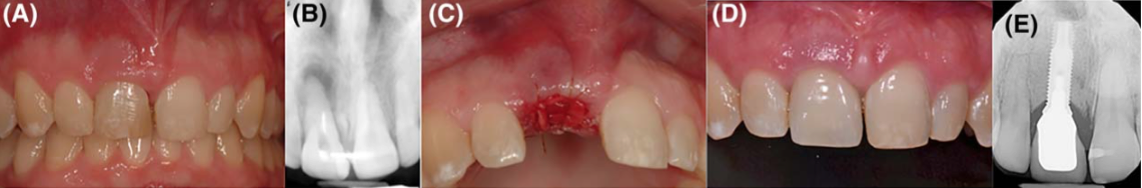 Atraumatic Ridge Preservation In The Esthetic Zone – Morning Huddle