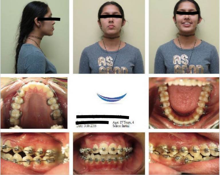 Treatment of Impacted Canines and Posterior Bilateral Crossbite ...