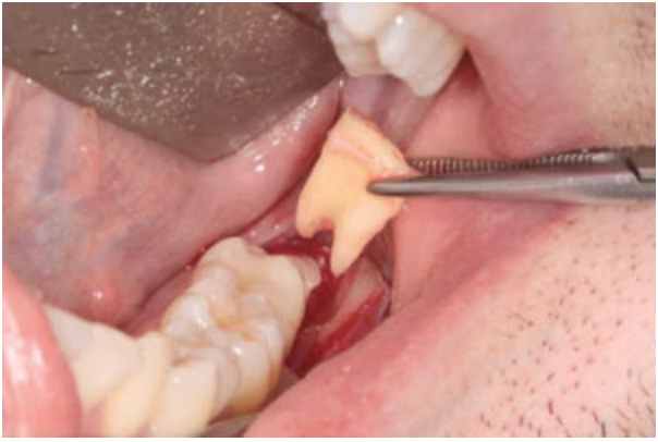 atraumatic-extractions-by-tooth-sectioning-morning-huddle