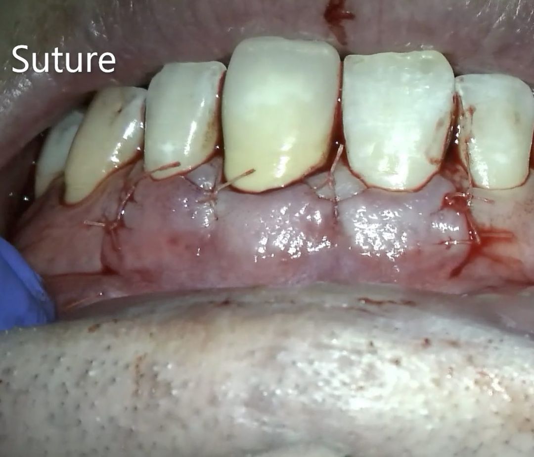 External Inflammatory Root Resorption – Morning Huddle