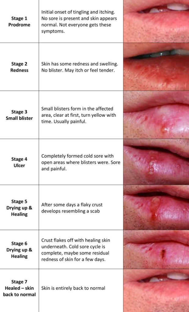 Labialis herpes Nasal Herpes